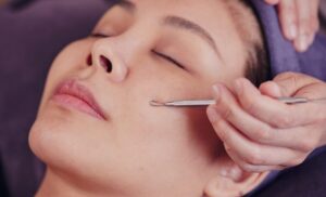 The Ways Facial Extractions Can Help with Clearing Acne