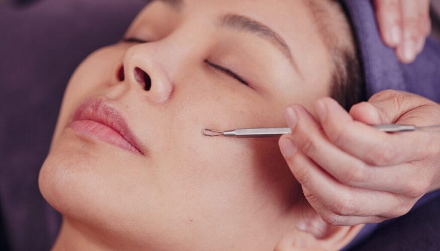 The Ways Facial Extractions Can Help with Clearing Acne