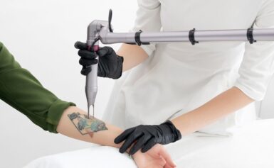 Does Tattoo Removal Leave Scars?