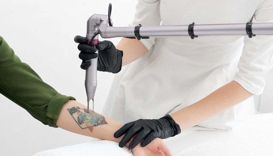 Does Tattoo Removal Leave Scars?