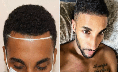 How Donor Area Management Differs for Afro Hair