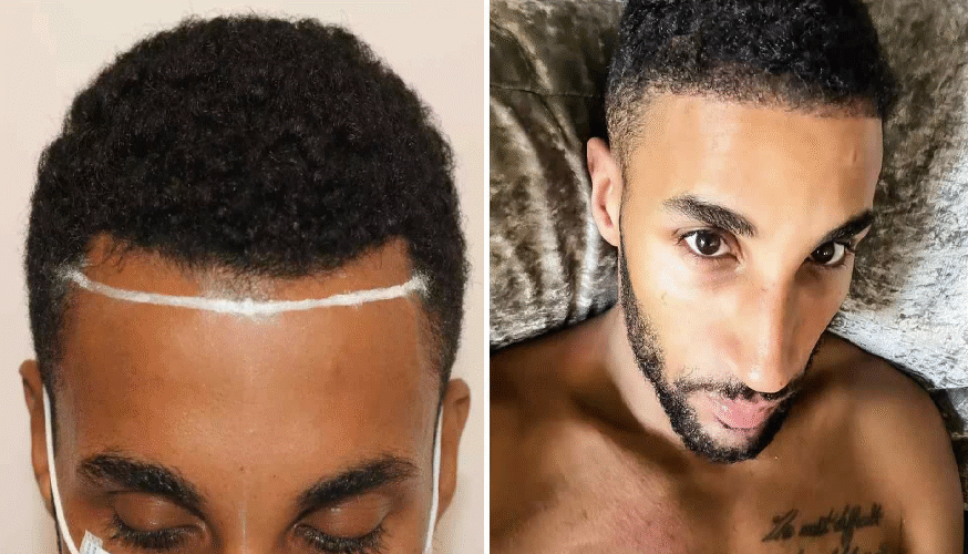 How Donor Area Management Differs for Afro Hair